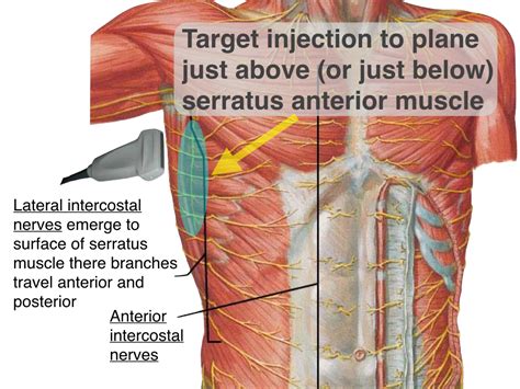 PECS/SERRATUS — Highland EM Ultrasound Fueled pain management