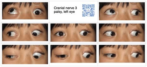 Microvascular Cranial Nerve Palsy