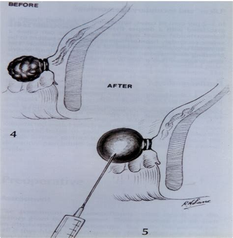 Rubber band ligation - kolhapurpilesclinic