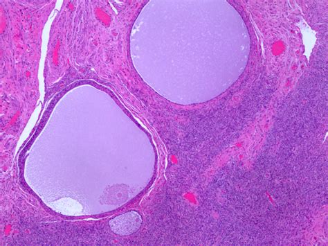 Pathology Outlines - Cortical inclusion cyst