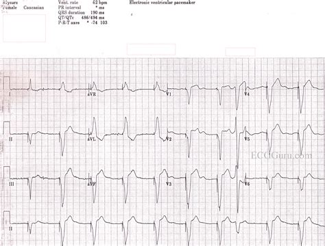 Paced Rhythm | ECG Guru - Instructor Resources