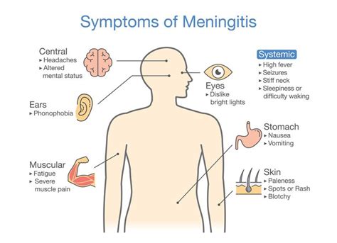 Learn about meningitis from Dr Christina | Meningitis, Bacterial ...