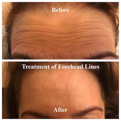 Best Forehead Lines Treatment Los Angeles & Santa Monica | Dr. Tanya ...