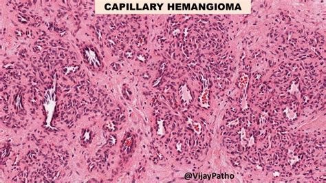 Capillary Hemangioma - Pathology Made Simple