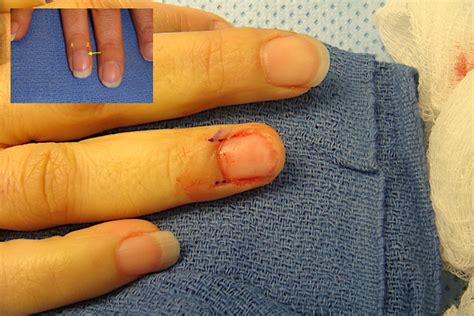 GLOMUS TUMOR | Hand Surgery Resource