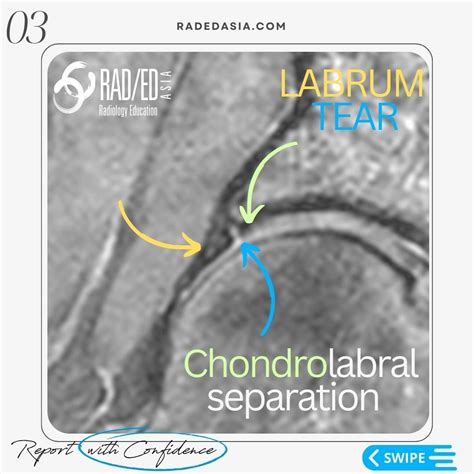 HIP LABRUM LABRAL TEAR MRI RADIOLOGY - Radedasia