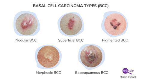 Basal Cell Carcinoma - Symptoms, Types and Pictures