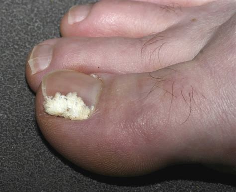 Will Toenail Grow Back After Fungus at Taylor Macias blog