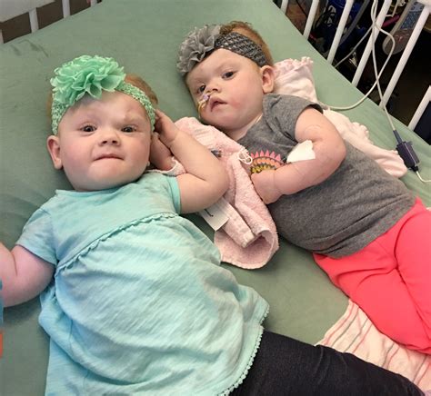 Formerly Conjoined Twins Thriving Five Months After Surgery | PEOPLE.com