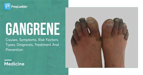 Gangrene: Causes, Symptoms, Risk Factors, Types, Diagnosis, Treatment ...