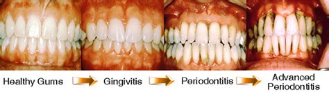 Gum Disease | Implant & Laser Periodontal Surgery Center | Las Cruces ...