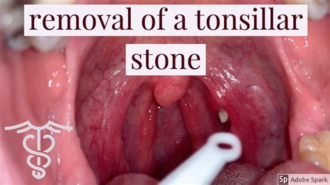 What Were Tongue Stones? Best 16 Answer - Ecurrencythailand.com