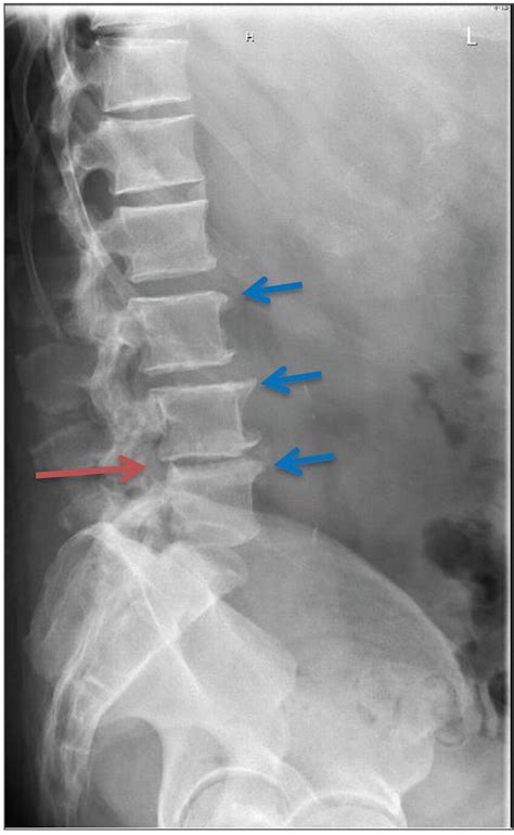 Types Of Lumbar Spine X Ray - Design Talk