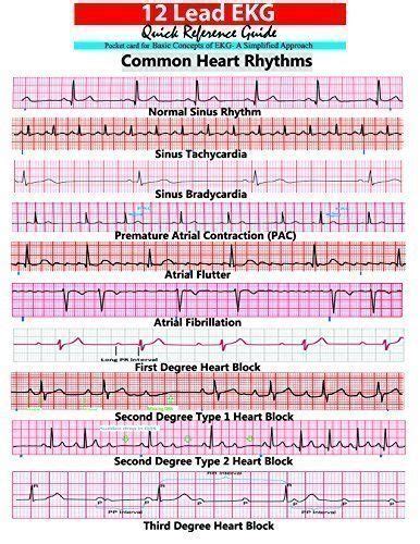 How To Read Ekg Strips For Dummies - Maryann Kirby's Reading Worksheets