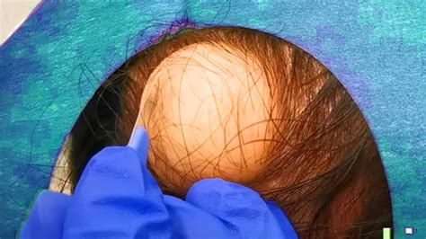 Giant Scalp Cyst Popping! DB's Pilar Cyst Removal!