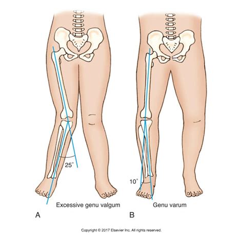 Decreased Ankle Dorsiflexion is Associated with Dynamic Knee Valgus