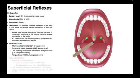 Gag Reflex | Procedure & Results Interpretation - YouTube