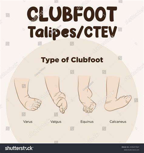 Club Foot Diagram