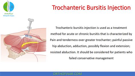 Trochanteric Bursitis Injection