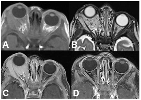 Orbital Tumors—Clinical, Radiologic and Histopathologic Correlation