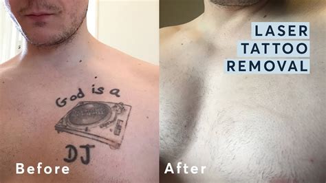 Top 77+ laser tattoo removal before and after latest - in.cdgdbentre