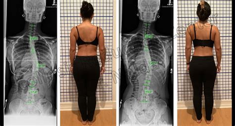 Scoliosis Exercises Before And After