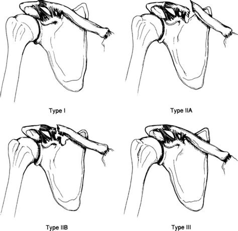 Causes Of Clavicle Fracture - Surgery for Clavicle Fracture (Broken ...