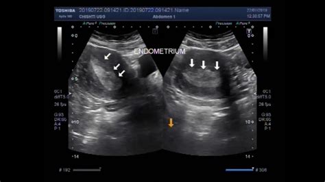 Ultrasound Video showing a case of endometrial hyperplasia. - YouTube