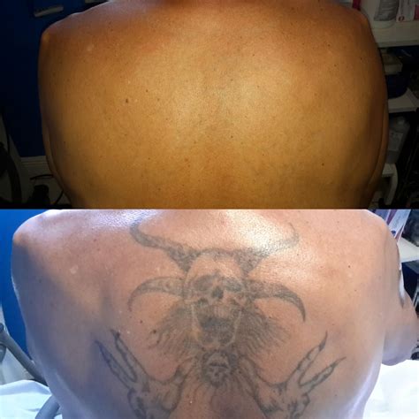 Looking For "Tattoo Removal Near Me" In Orlando? Call Us!