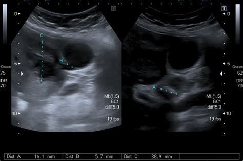 Gallbladder perforation - radiological aspects, types and causes ...