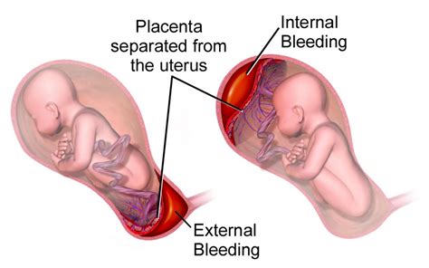 Antepartum Hemorrhage | Concise Medical Knowledge