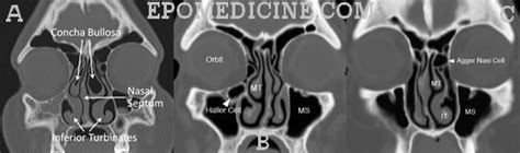 Left Ostiomeatal Complex