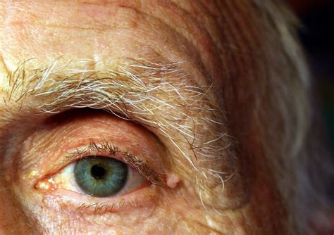 Cataract Surgery Side Effects - Merrillville, IN