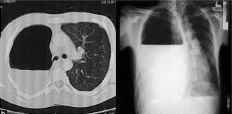 Right side hydropneumothorax. | Download Scientific Diagram