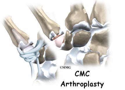 Artificial Joint Replacement of the Thumb - eOrthopod.com