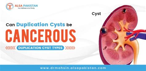 Can duplication cysts be cancerous? | Duplication cyst types