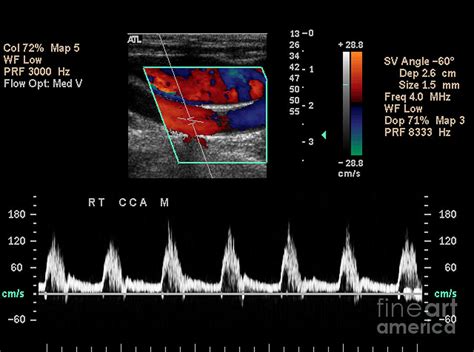 Carotid Duplex Ultrasound Exam #4 Photograph by Living Art Enterprises ...