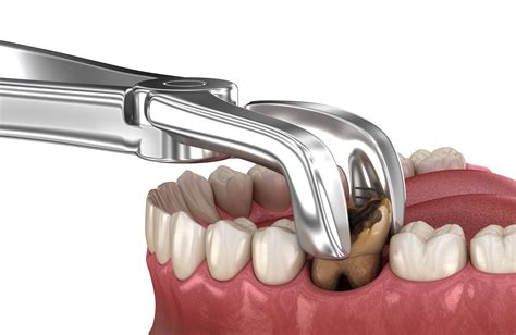 Vađenje umnjaka, apikotomija, sinus lift - Dragaš Dental Design