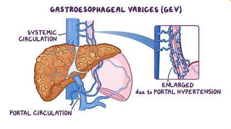 Esophageal Varices Anatomy