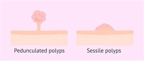 Types of endometrial polyps: sessile and pedunculated