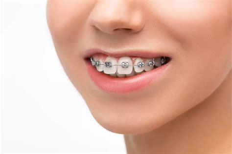 Removable Braces - DentaCenter