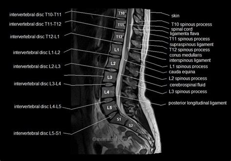 MRI lumbar spine sagittal cross sectional anatomy image 7 | Mri ...