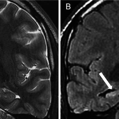 A MRI of a ganglioglioma in a 45-year-old man with refractory left ...