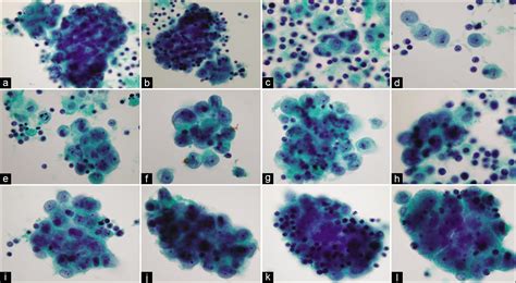 The panorama of different faces of mesothelial cells - CytoJournal