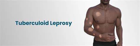 Tuberculoid Leprosy: Symptoms, Diagnosis, Treatment, Prevention