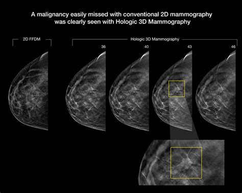 3D Mammography Improves Cancer Detection in Dense Breasts - OGP News