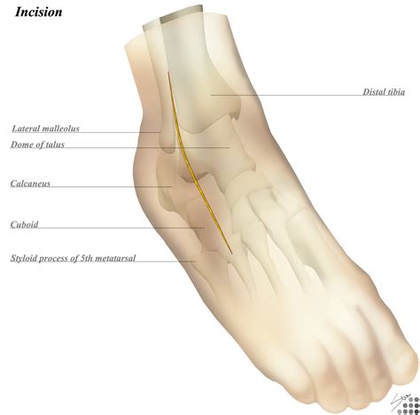 Where Is Lateral Malleolus Located