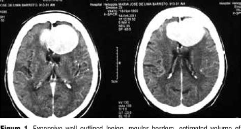 Figure 1 from Diffuse brain swelling following falcine meningioma ...