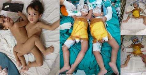 20 Doctors Separate Conjoined Twins After 12 Hours Surgery(Photos)