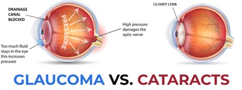 Cataract Vs Glaucoma: 13 Must Know Differences and Facts - Public ...